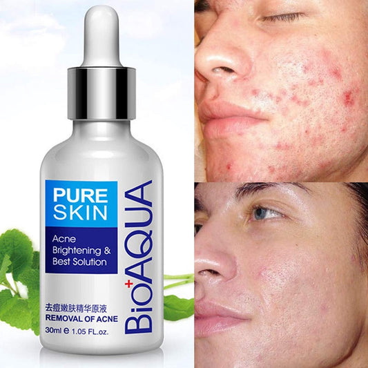 TONICO ANTI-ACNE BIOAQUA